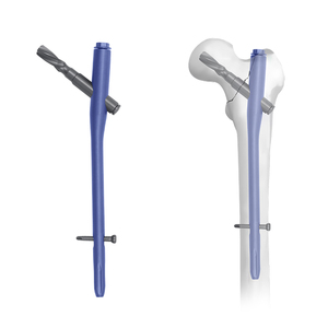 PFNA Titanium Alloy Hip Fixation System