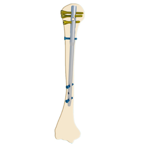 Titanium Alloy Multi-Dimensional Locking Intramedullary Nail Combination Set Implant Set For Humeral