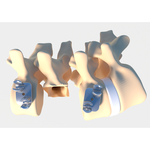 Customizable Minimally Invasive Spine Surgery Titanium Implantable System Fule Combination