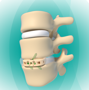 Posterior Lumbar Interbody Fusion Cage Spine Orthopedic Implants