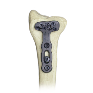 CANWELL Distal Radius Volar Locking Plates Titanium AO Standard